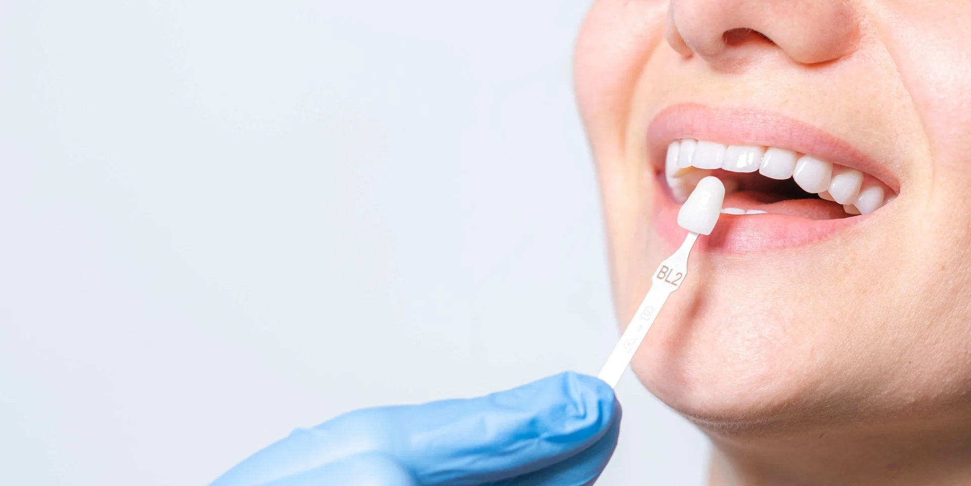 cardiff dental whitening shade guide comparison Whitening shade guide being compared to a patient's teeth