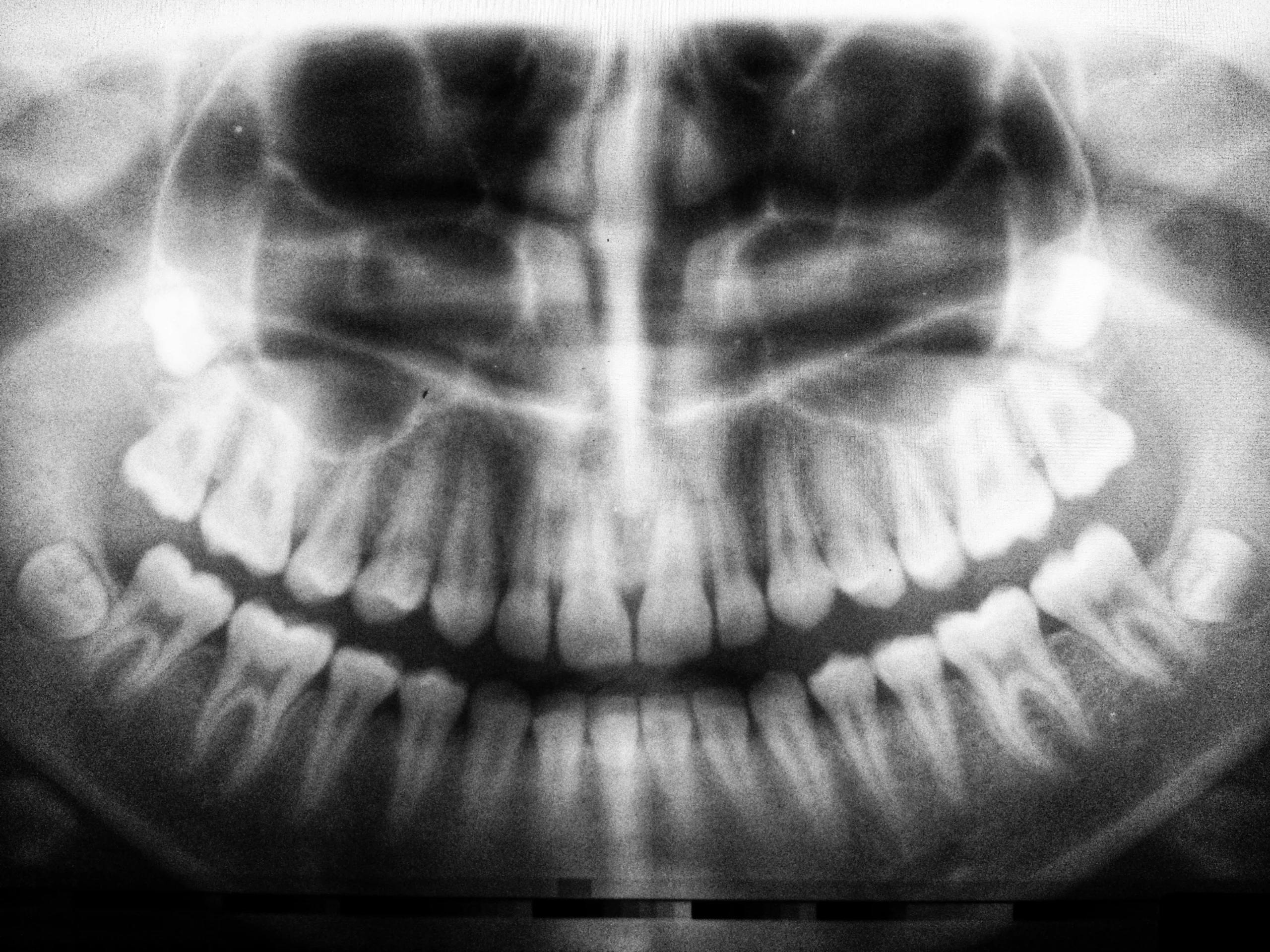 cardiff dental wisdom teeth panoramic xray Panoramic dental X-ray showing wisdom teeth positions