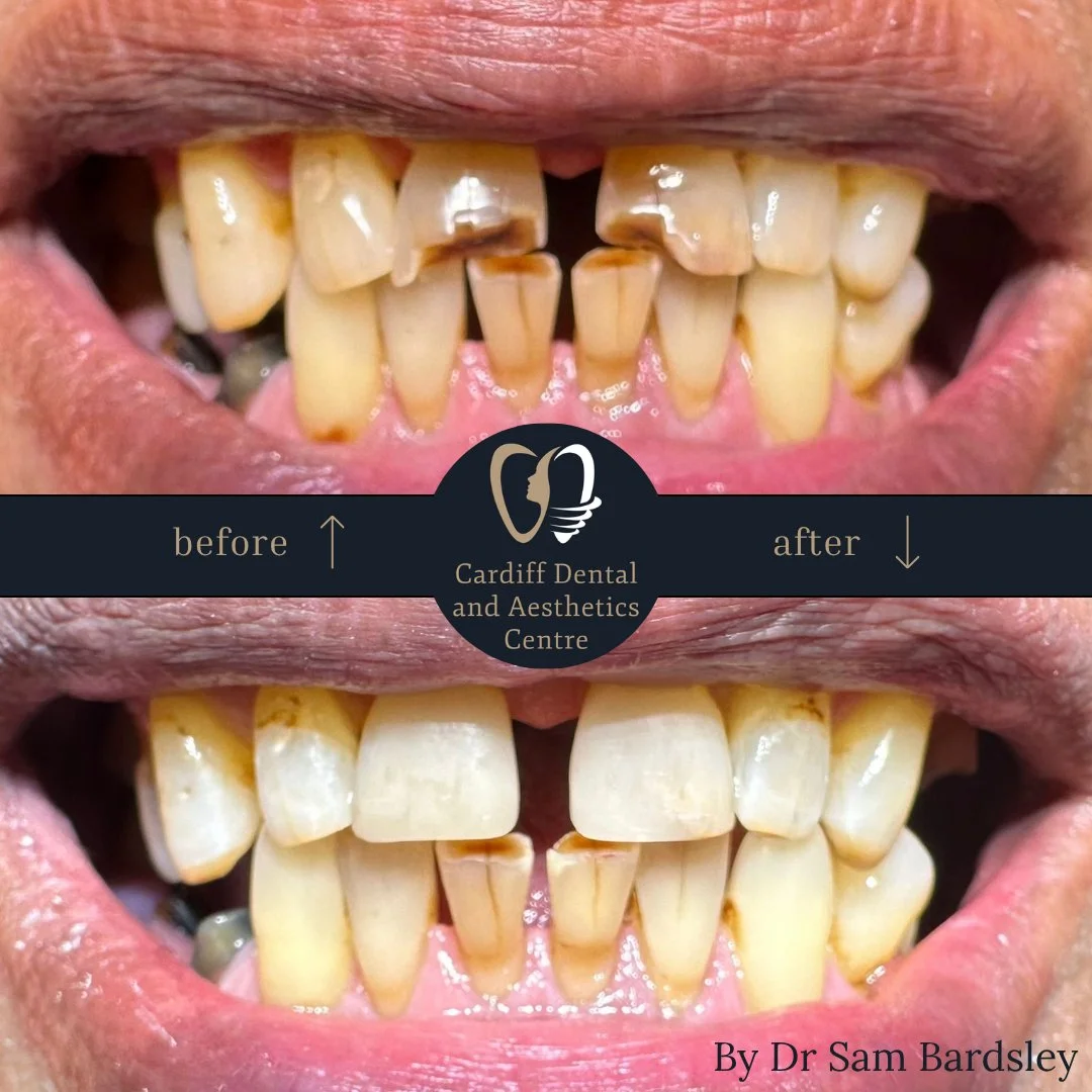 composite bonding result by dr sam bardsley Composite bonding before and after by Dr Sam Bardsley
