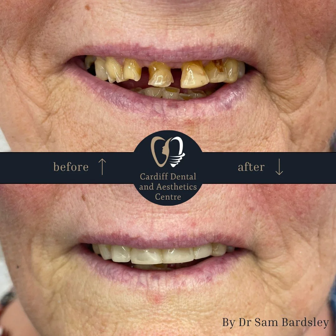 composite bonding result by dr sam bardsley Composite bonding before and after by Dr Sam Bardsley
