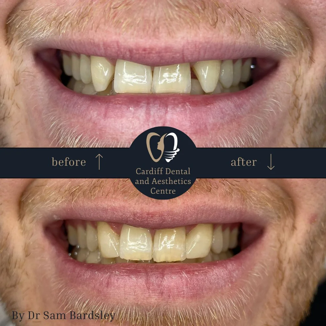 composite bonding result by dr sam bardsley Composite bonding before and after by Dr Sam Bardsley